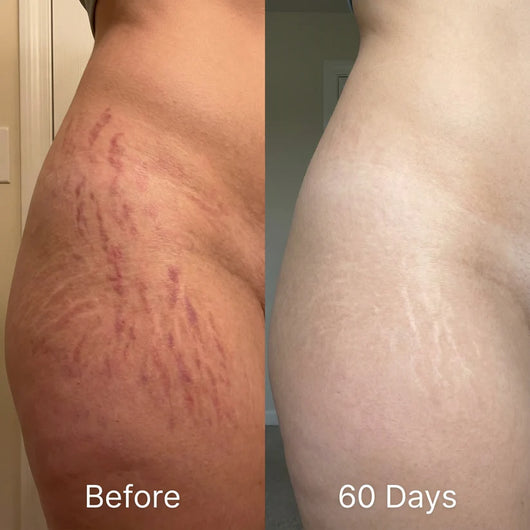 Glowli Silicone Scar Stick for Face & Body