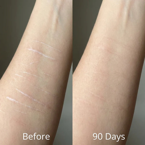 Glowli Silicone Scar Stick for Face & Body