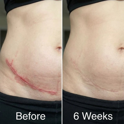 Glowli Silicone Scar Stick for Face & Body